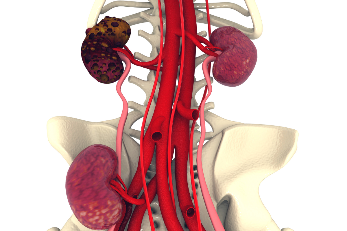 Kidney Disease metabolic management