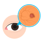 Eye complication in diabetes